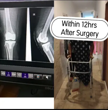 Post op patient 12 hours after total knee replacement Surgery